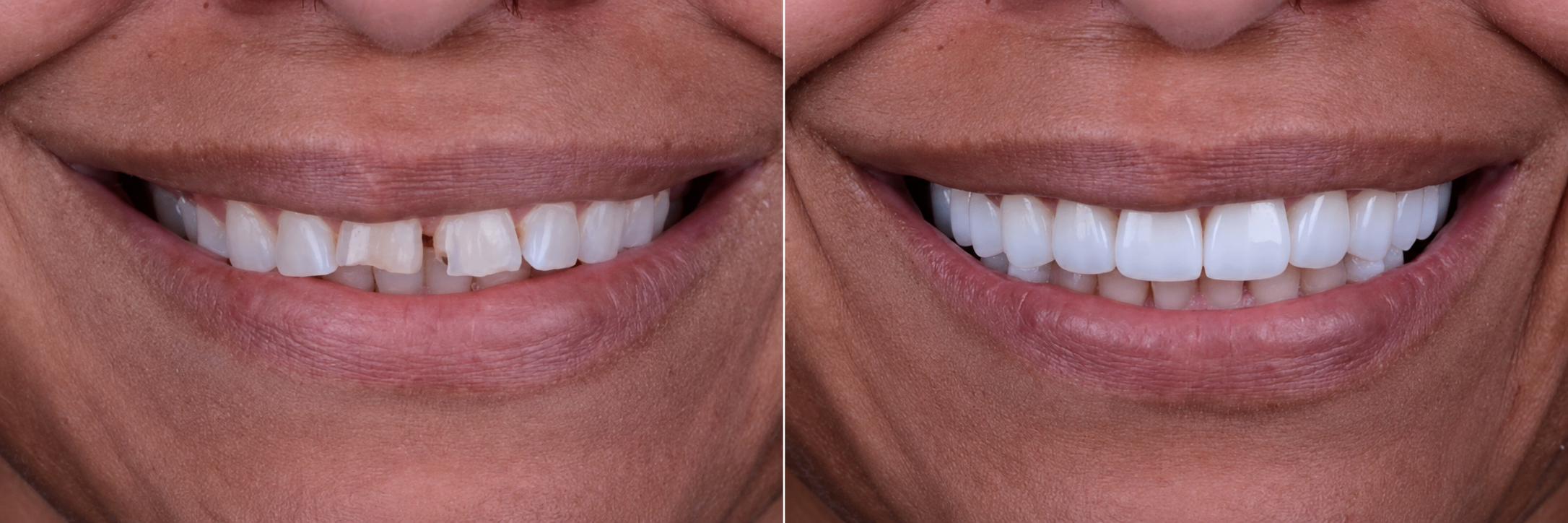 Smile transformation case 01, before on the left and after on the right