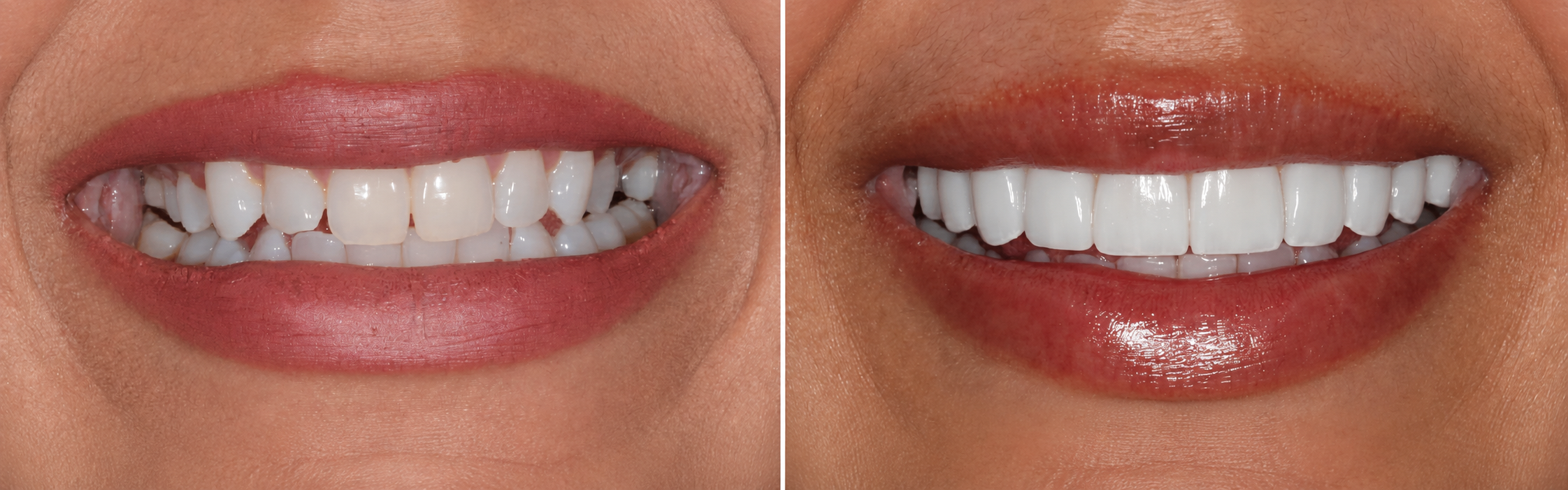 Smile transformation case 02, before on the left and after on the right