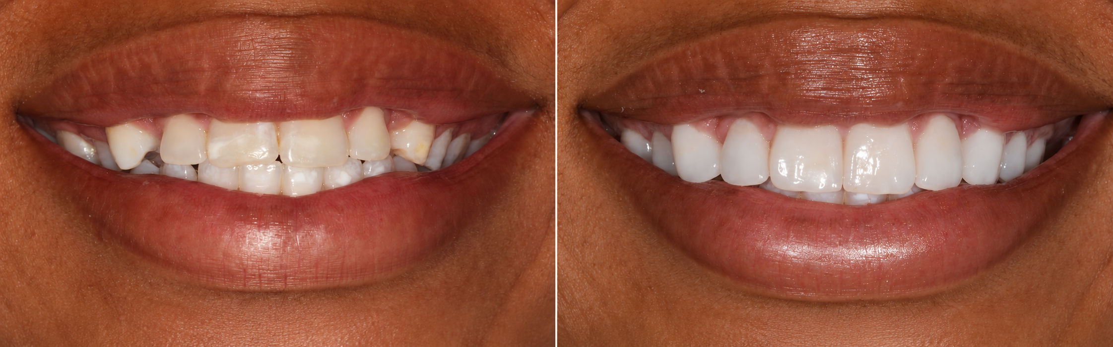 Smile transformation case 03, before on the left and after on the right