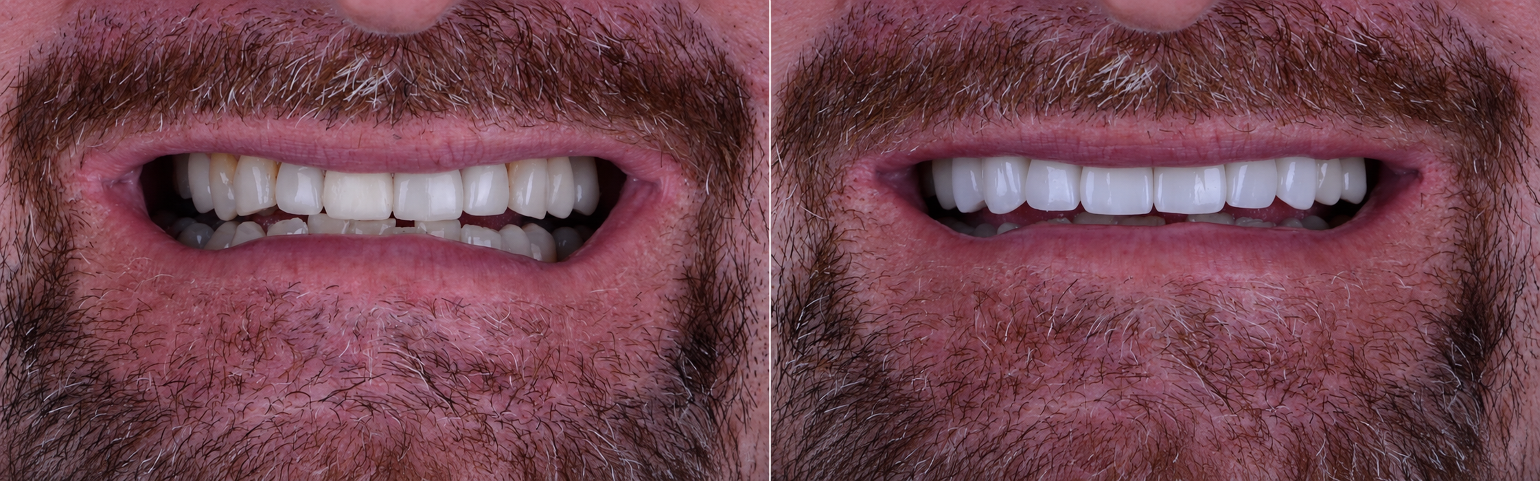 Smile transformation case 04, before on the left and after on the right