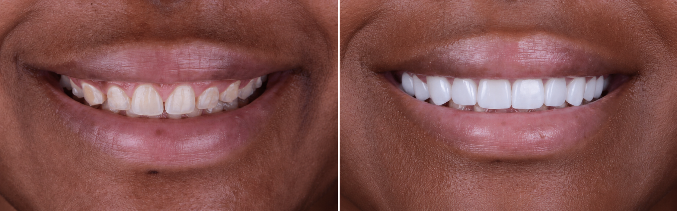 Smile transformation case 05, before on the left and after on the right