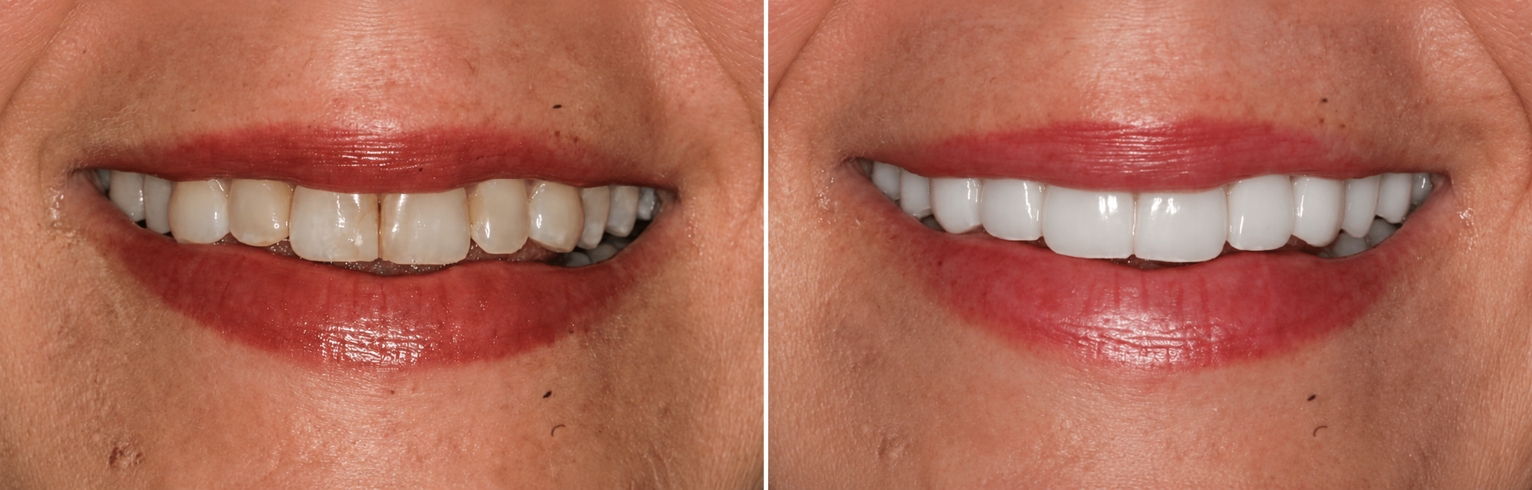 Smile transformation case 06, before on the left and after on the right