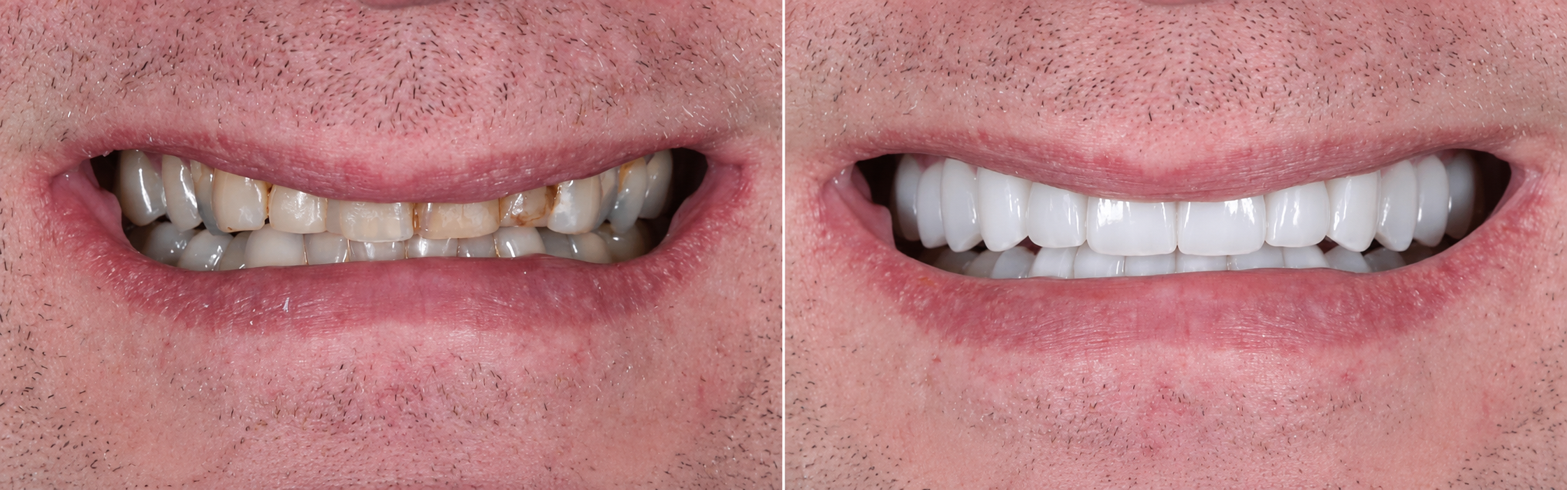 Smile transformation case 07, before on the left and after on the right