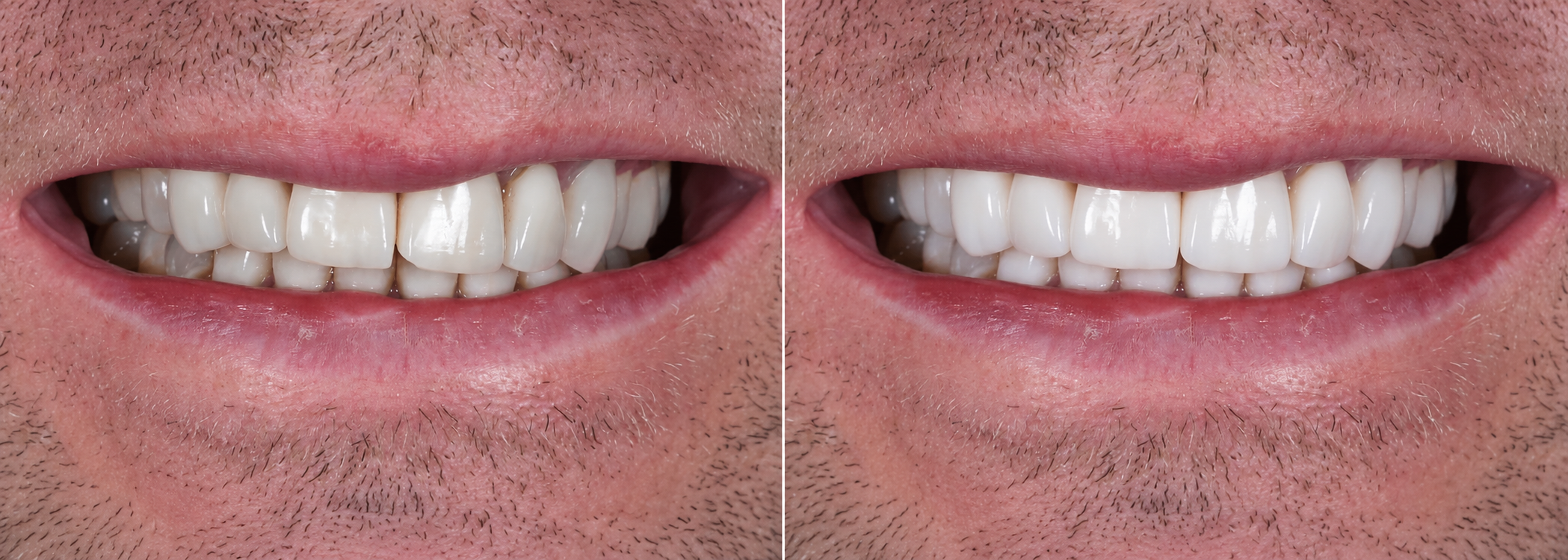 Smile transformation case 08, before on the left and after on the right