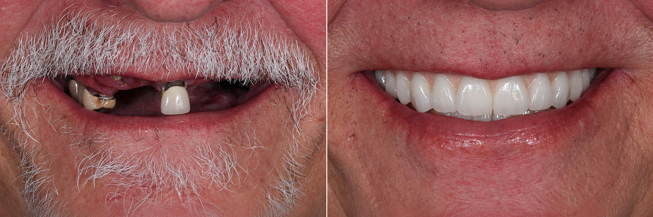 Smile transformation case 09, before on the left and after on the right